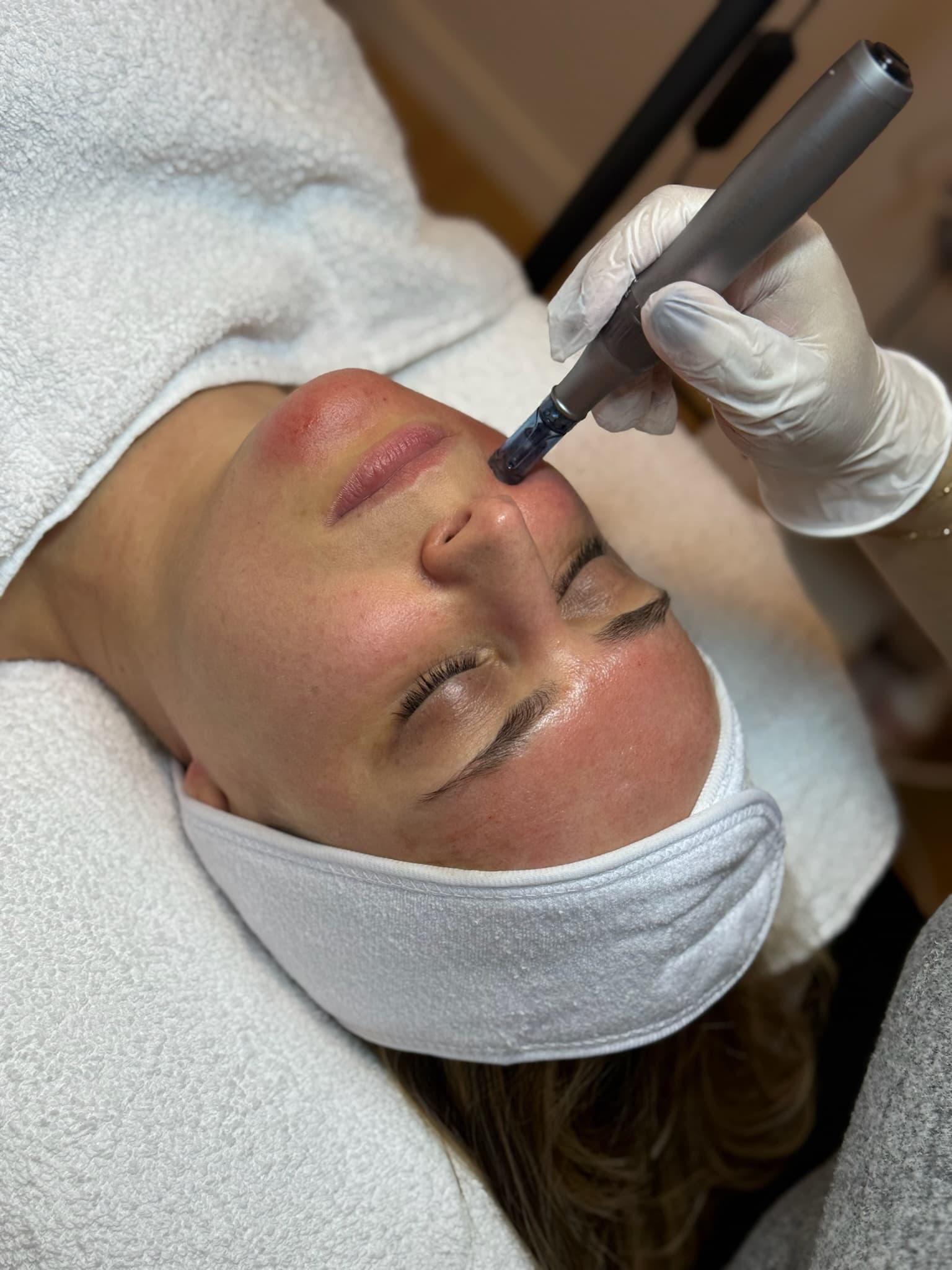 Sahel Beauty Frankfurt — microneedling treatment
