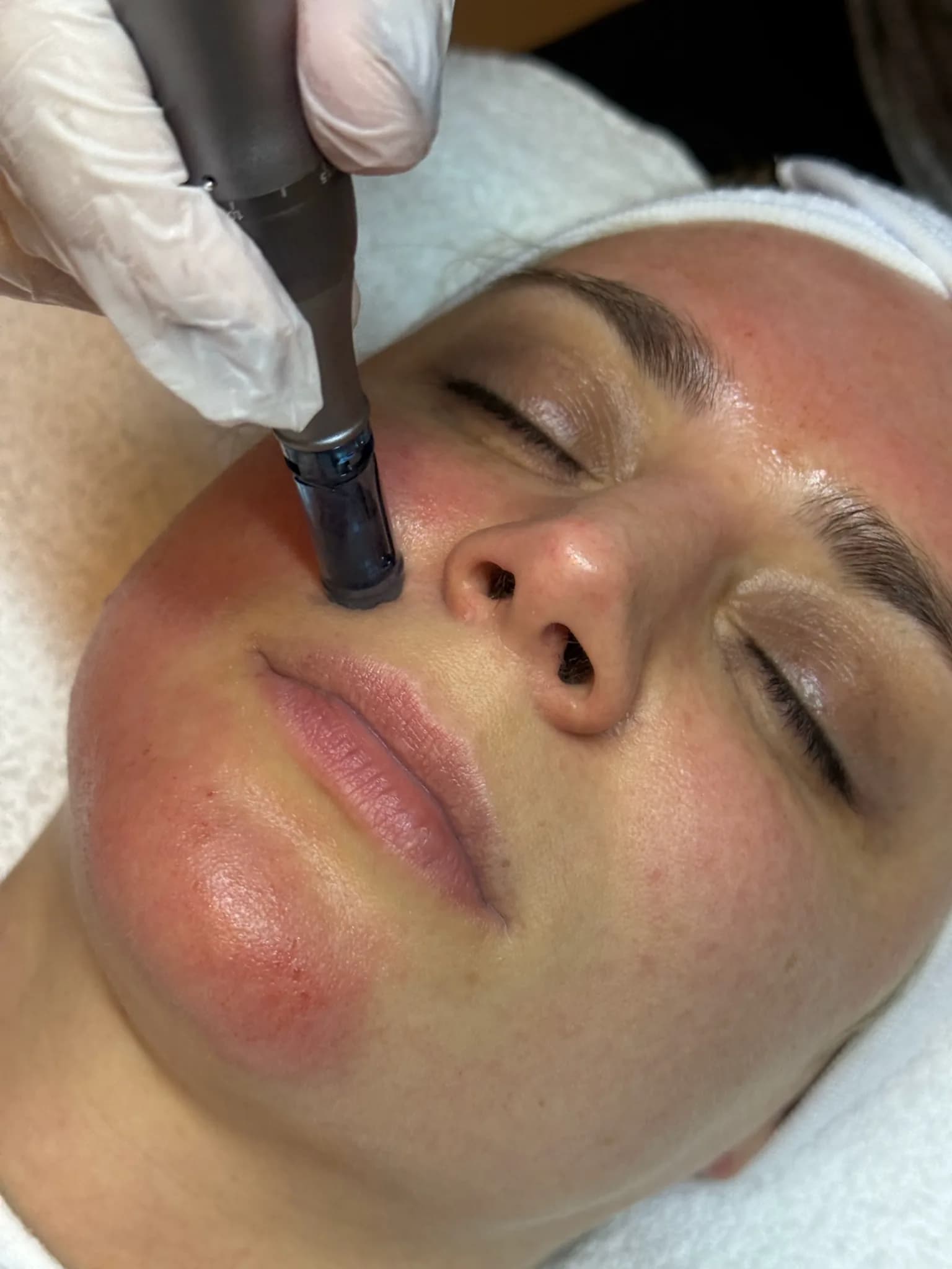 Microneedling in Frankfurt — Hauterneuerung mit Soforteffekt — Sahel Beauty Frankfurt (Bild 1)