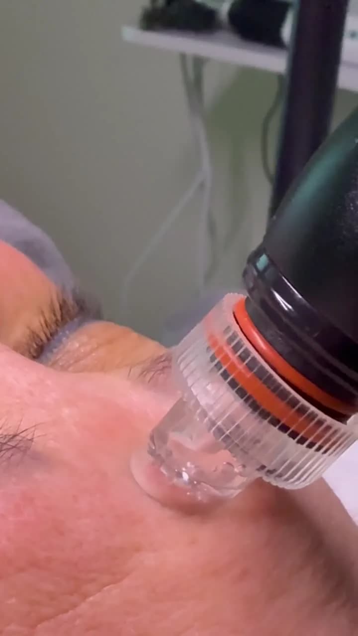 Aquafacial in Frankfurt — Tiefenreinigung mit Sofort-Glow — Sahel Beauty Frankfurt (Bild 12)