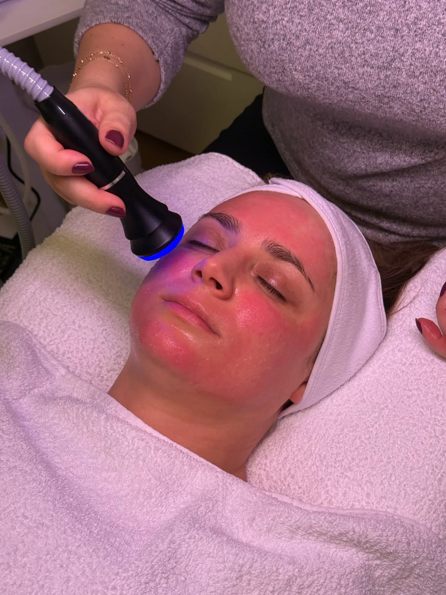Radiofrequenz-Lifting in Frankfurt — straffere Haut ohne OP — Sahel Beauty Frankfurt (Bild 3)